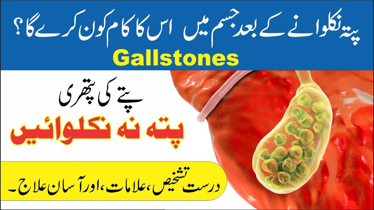 Gallstones || پتہ نہ کلوائیں پتے کی پتھری کا علاج || Al Huda Guidance